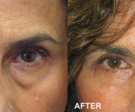 Five Things to Know if You’re Considering Blepharoplasty