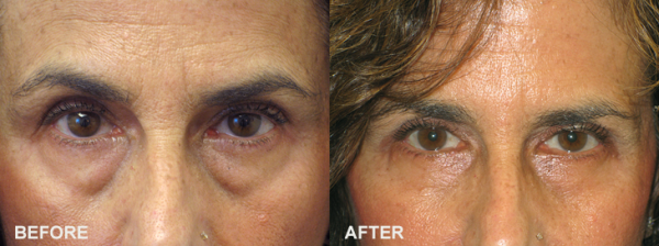 Five Things to Know if You’re Considering Blepharoplasty