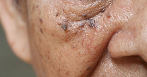 Skin Tags: Where They Come From and Are They Harmful?