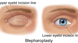 The Misconception of Ethnic Eyelid Surgery