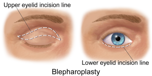 The Misconception of Ethnic Eyelid Surgery