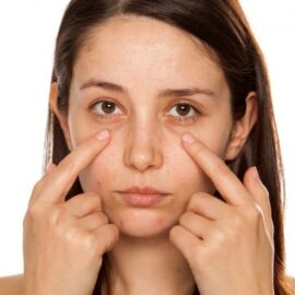Solutions for the Dark Circles Under Your Eyes