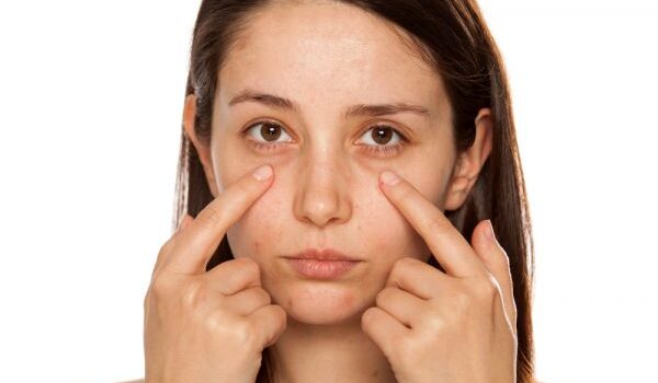 Solutions for the Dark Circles Under Your Eyes