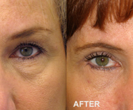 Who Are the Best Candidates for Blepharoplasty?