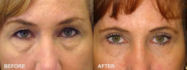 Who Are the Best Candidates for Blepharoplasty?