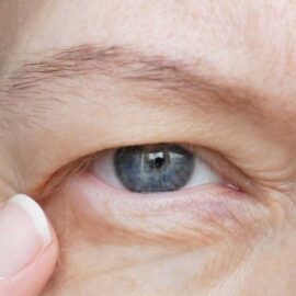 Things Are Looking Up: Understanding and Reversing Drooping Eyelids