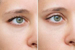 ptosis before and after example