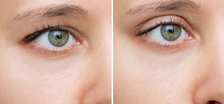 ptosis before and after example