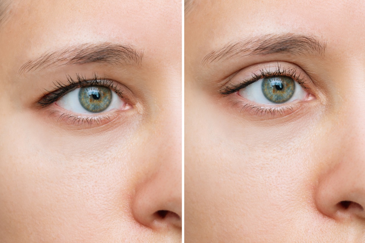 Functional blepharoplasty myron tanenbaum md