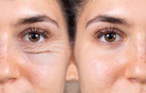 woman's eyes before and after blepharoplasty