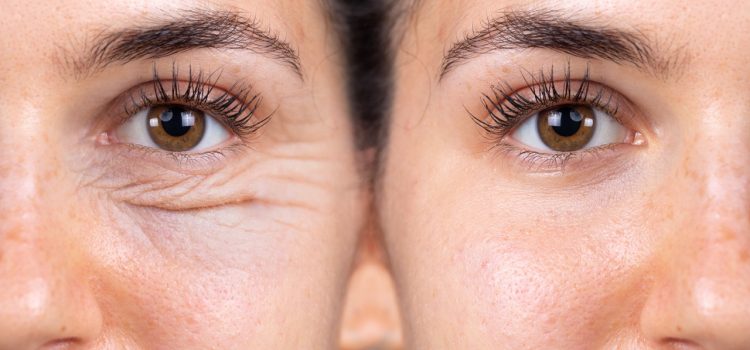 woman's eyes before and after blepharoplasty